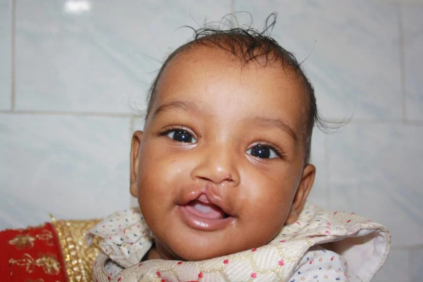 Cleft Lip & Palate Program